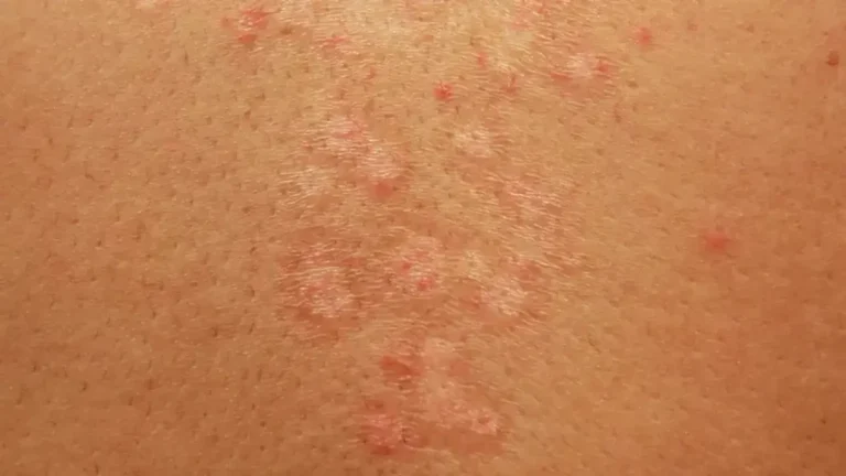 Infecțiile fungice ale pielii: cauze, simptome și tratament Infecțiile fungice ale pielii